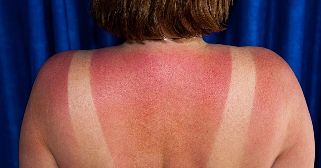 What not to do if you have a sunburn