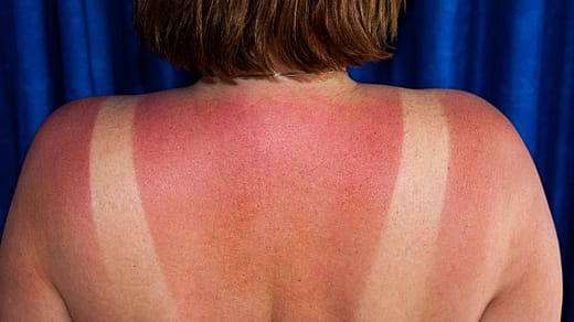 What not to do if you have a sunburn
