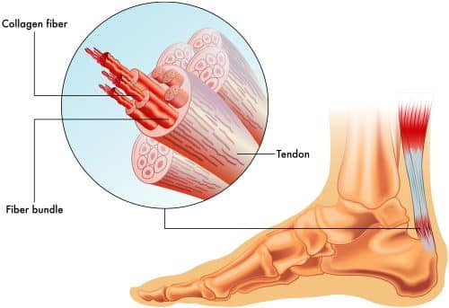 Achilles tendinopathy: Symptoms and causes and how to treat Achilles tendinopathy